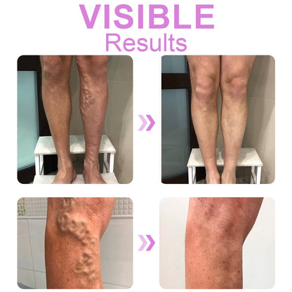 Dobshow™ Varicose Veins Cream💥