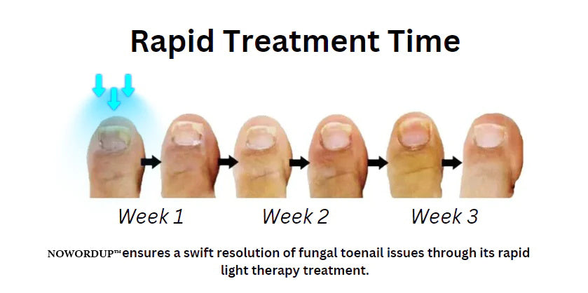 NOWORDUP™Revolutionary Light Therapy Device for toenail diseases.