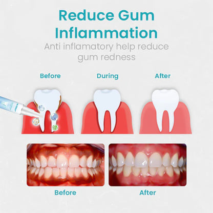 Nurbini™ Gum Shield Therapy Gel (Last Day Promotion 80% OFF🔥)