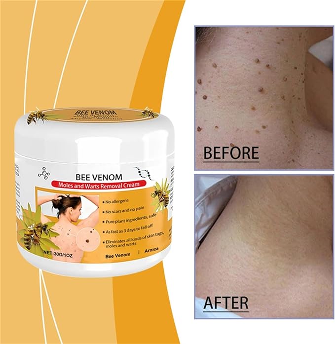 🐝🐝 Dobshow™Bee Venom Mole and Wart Treatment Cream(👨‍⚕AAD RECOMMENDS)